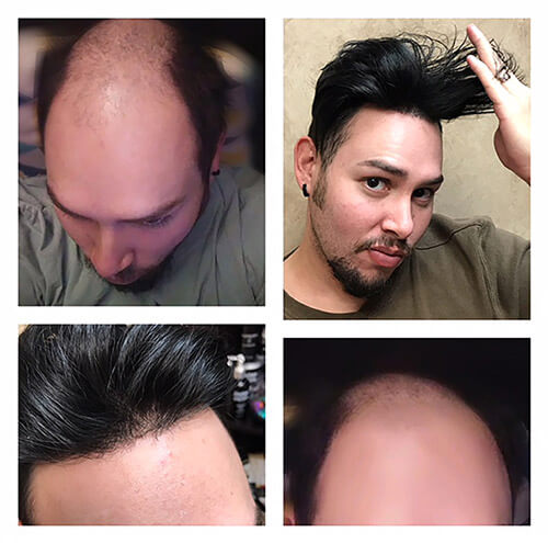 Collage of mens hair system results. Front view of a younger, dark-haired man with balding crown after hair restoration. Balding crown is completely gone and he's running his fingers through his hair, holding up his bangs.