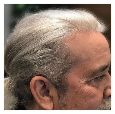 older man with balding head after treatment
