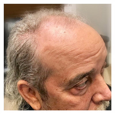 older man with balding head before treatment